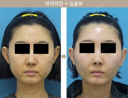 브이라인 + 심술보