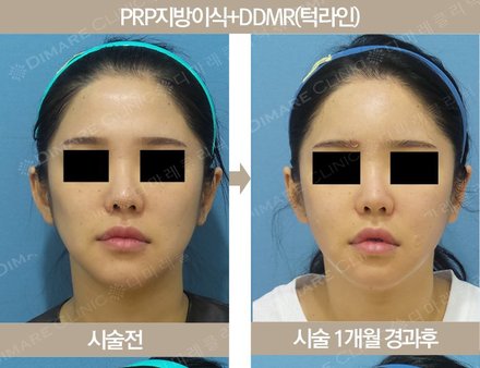 PRP지방이식 + DDMR(턱라인)