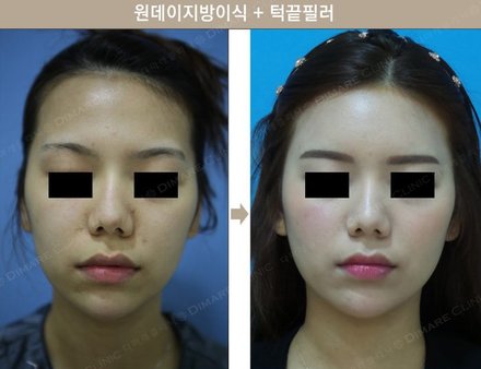 원데이지방이식 + 턱끝필러