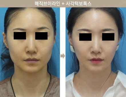매직브이라인 + 사각턱보톡스