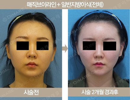 매직브이라인 + 일반지방이식(전체)