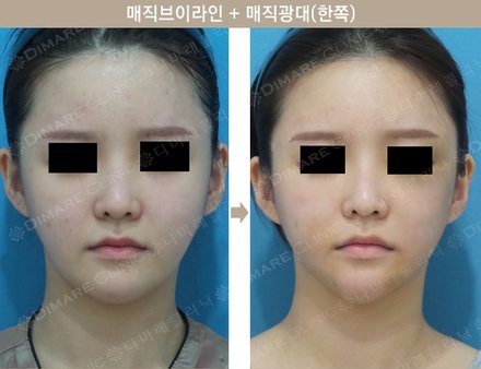 매직브이라인 + 매직광대