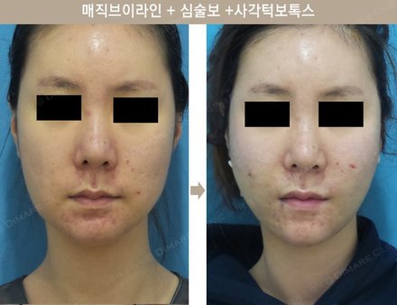 매직브이라인 + 심술보 + 사각턱보톡스