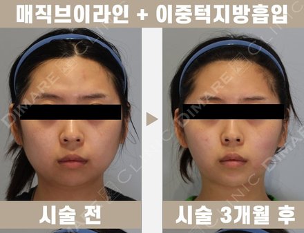 매직브이라인 + 이중턱지방흡입