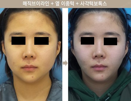 매직브이라인 + 옆 이중턱 + 사각턱보톡스