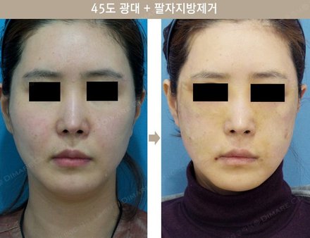 45도 광대 + 팔자지방제거
