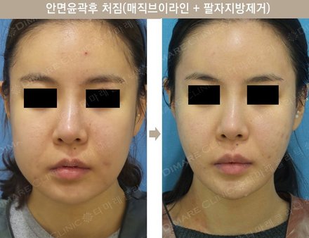 매직브이라인 + 팔자지방제거