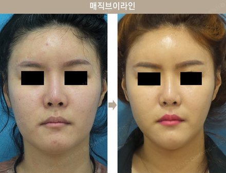 매직브이라인