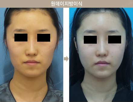 원데이지방이식