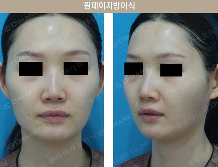 원데이지방이식
