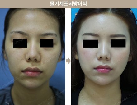 지방이식