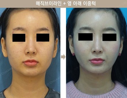 매직브이라인 + 옆 아래 이중턱