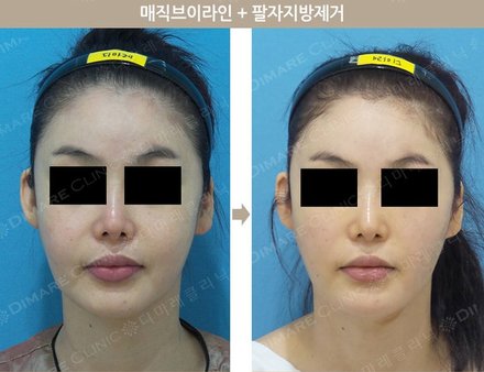 매직브이라인 + 팔자지방제거