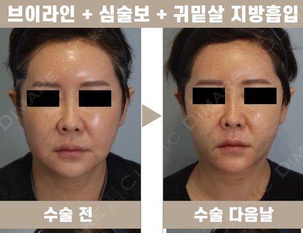 브이라인+심술보+귀밑살 지방흡입 + 턱BTX