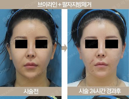 브이라인 + 팔자지방제거