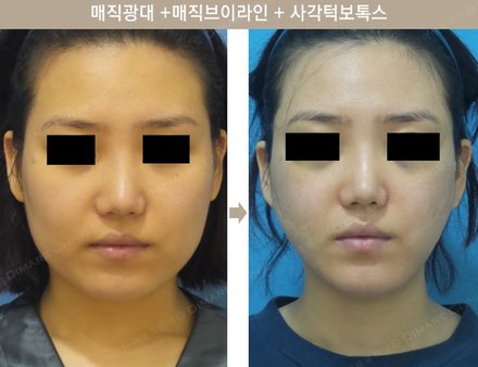 매직광대 + 매직브이라인 +사각턱보톡스