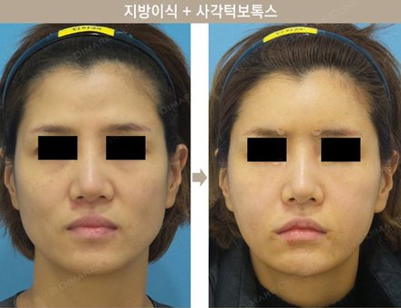 원데이지방이식 + 사각턱보톡스