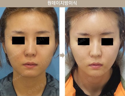 원데이지방이식