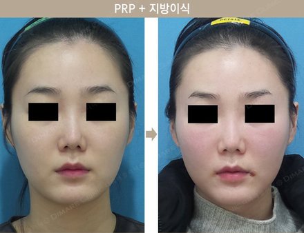 PRP + 지방이식