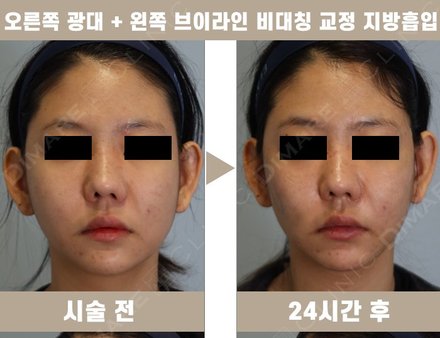 오른쪽 광대 + 왼쪽 브이라인 비대칭 교정 지방흡입