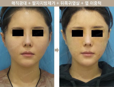 매직광대 + 팔자지방제거 + 뒤쪽 귀 옆살 + 옆 이중턱