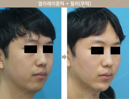 옆아래이중턱 + 필러(무턱)