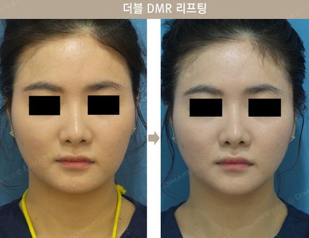 더블 DMR 리프팅