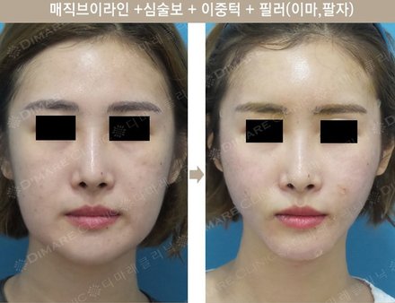 매직브이라인 + 심술보 + 아중턱 + 필러(이마, 팔자)