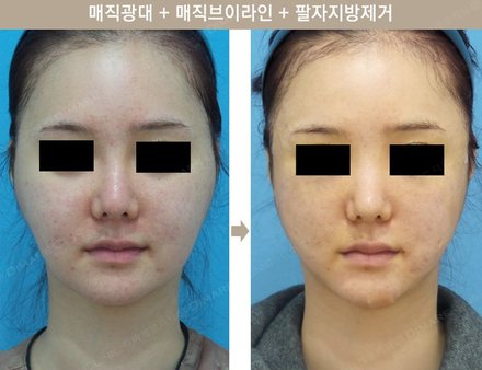 매직광대 + 매직브이라인 + 팔자지방제거