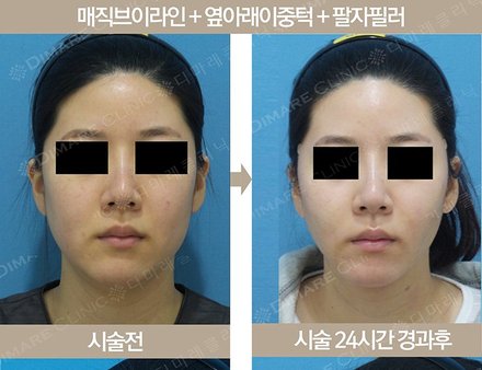 매직브이라인 + 옆아래이중턱 + 팔자필러
