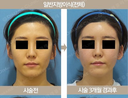 일반지방이식(전체)