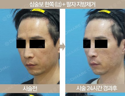 심술보 한쪽 (Lt) + 팔자지방제거