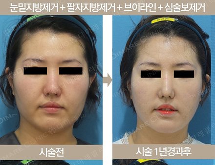눈밑지방제거 + 팔자지방제거 + 브이라인 + 심술보제거