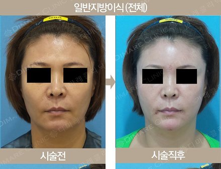 일반지방이식 (전체)