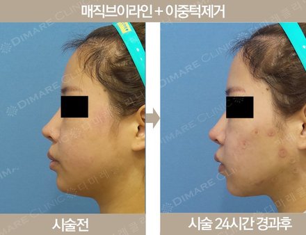 매직브이라인 + 이중턱지방제거