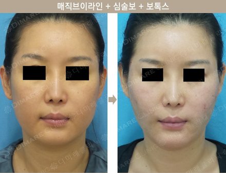 매직브이라인 + 심술보 + 턱보톡스