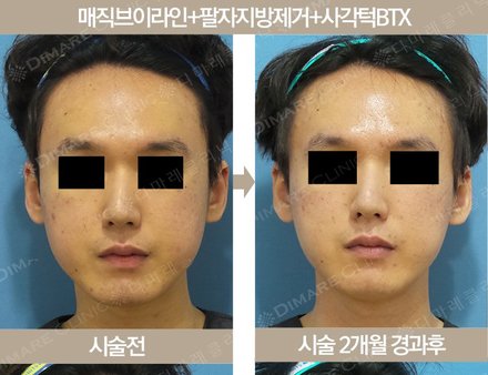 매직브이라인+팔자지방제거+사각턱BTX