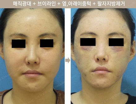 매직광대 + 매직브이라인 + 옆아래이중턱 + 팔자지방제거