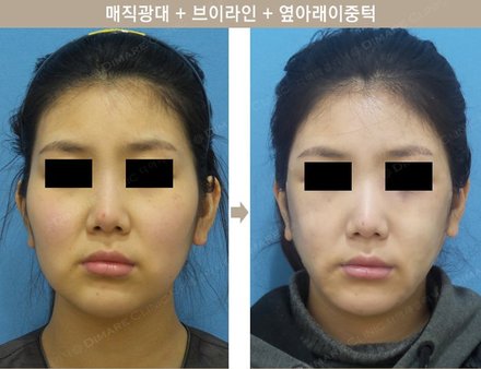 매직광대 + 브이라인 + 옆아래이중턱