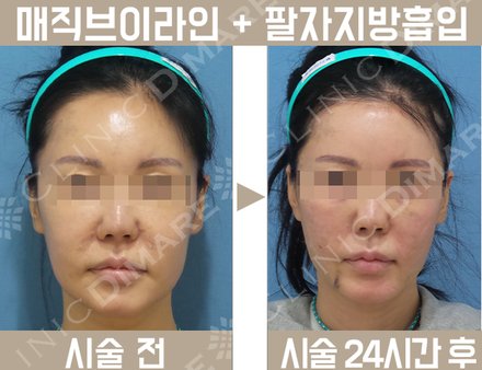 매직 브이라인 + 팔자지방제거