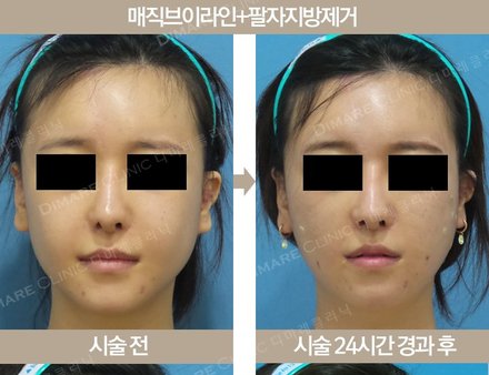 매직브이라인 + 팔자지방제거