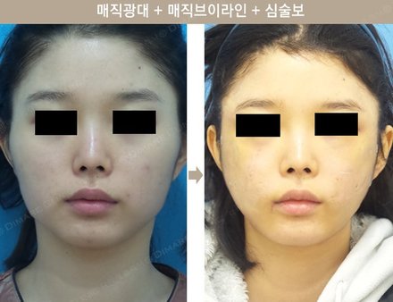 매직광대 + 매직브이라인 + 심술보
