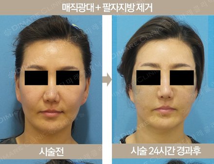 매직광대 + 팔자지방제거