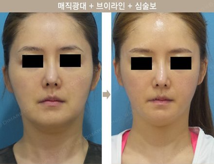 매직광대 + 매직브이라인 + 심술보