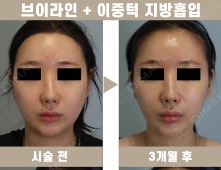 매직브이라인 + 이중턱 지방흡입