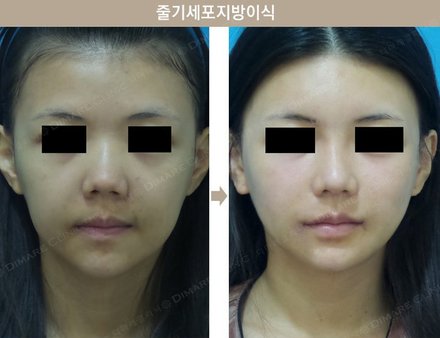 줄기세포 지방이식