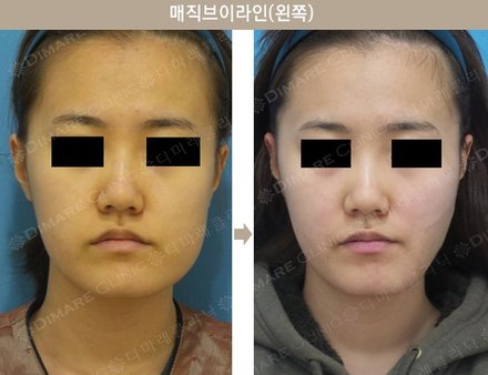 매직브이라인