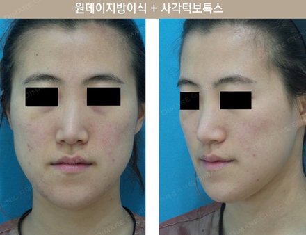 원데이지방이식 + 사각턱보톡스