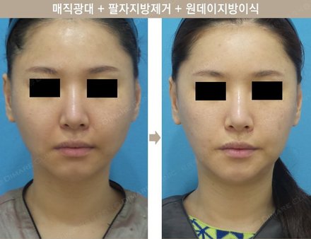 매직광대 + 팔자지방제거 + 원데이지방이식