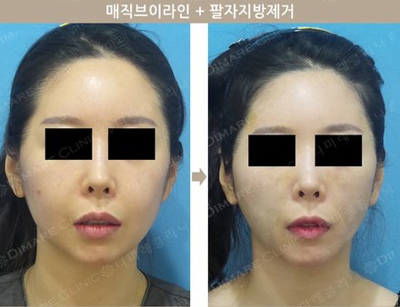 매직브이라인 + 팔자지방제거